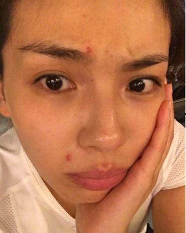 明星长痘吗,揭秘明星护肤背后的秘密