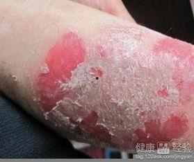 明星银屑病,勇敢面对挑战的他们