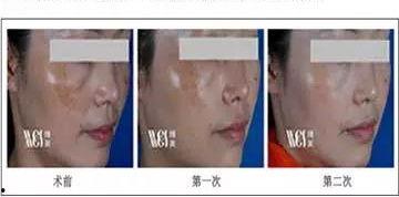 云浮网红祛斑霜有用吗,真实效果揭秘，祛斑神器还是坑钱货？