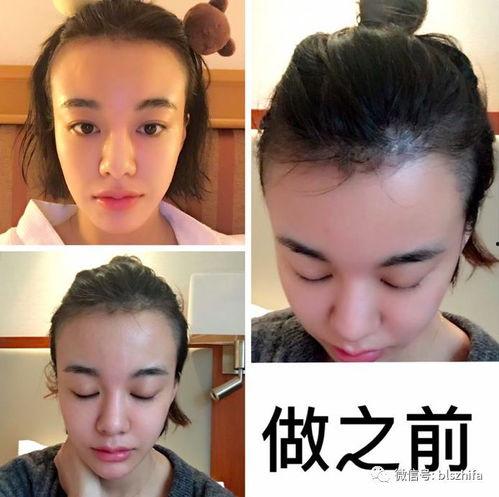 明星植发有什么好处